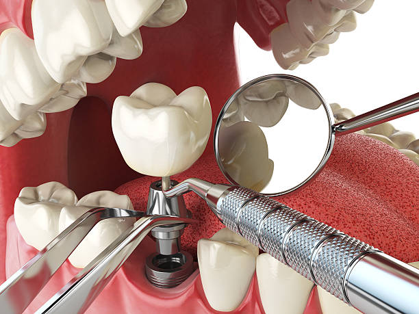 Best Emergency Tooth Extraction in Estancia, NM